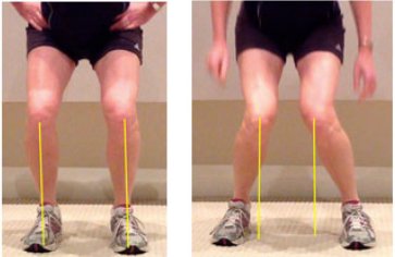 Effective Solutions For Valgus Knees - SelectFlex