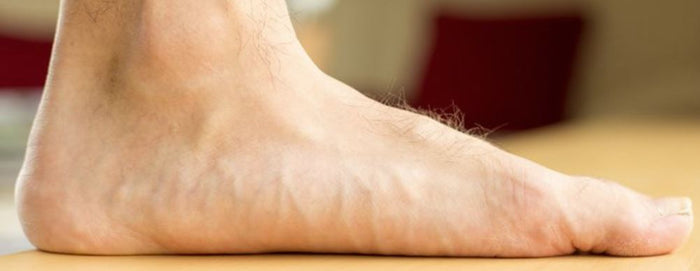 HOW TO PREVENT AND TREAT FLAT FEET - SelectFlex