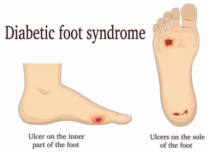 TAKING CARE OF YOUR FEET IF YOU HAVE DIABETES - SelectFlex