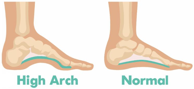 THE IMPORTANCE OF FOOT CARE FOR PEOPLE WITH HIGH ARCHES - SelectFlex